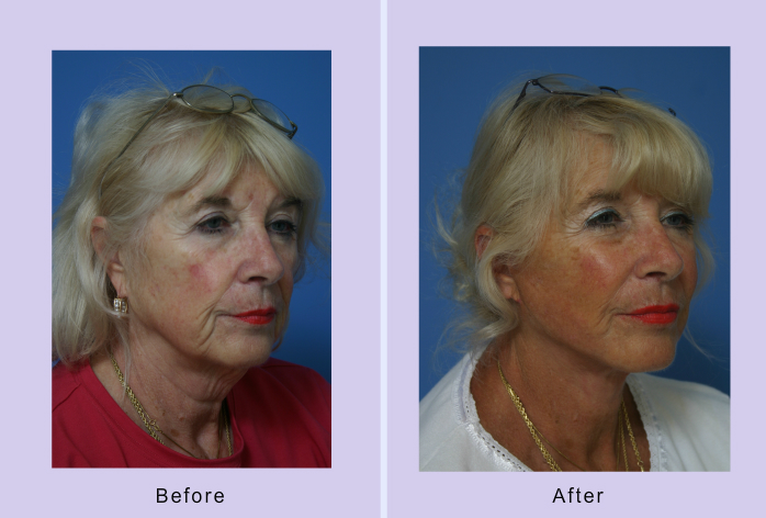 Before and After Image: facelift and mini facelift – case 12 - right-front-oblique