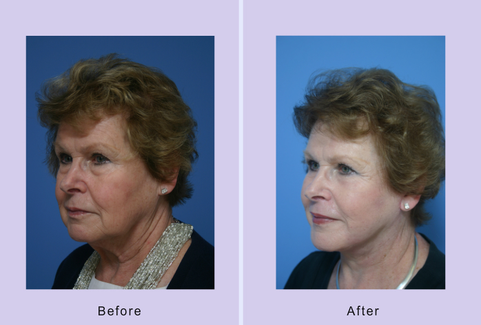 Before and After Image: facelift and minifacelift – case 13 - left-front-oblique