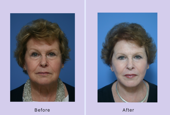 Before and After Image: facelift and minifacelift – case 13 - front