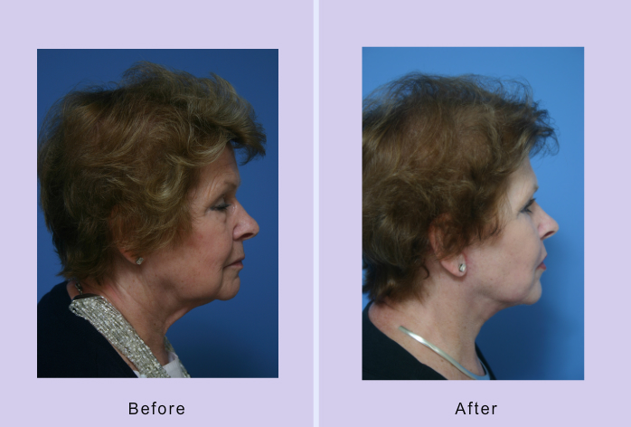 Before and After Image: facelift and minifacelift – case 13 - right-side