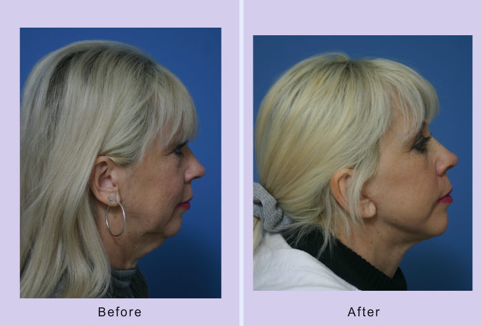 Before and After Image: facelift and mini facelift – case 14 - right-side