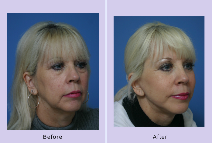 Before and After Image: facelift and mini facelift – case 14 - right-front-oblique