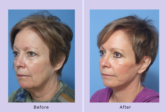 Before and After Image: facelift – case 15 - left-front-oblique