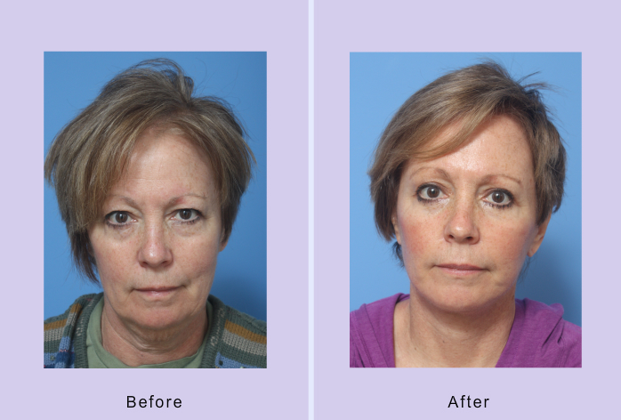 Before and After Image: facelift – case 15 - front