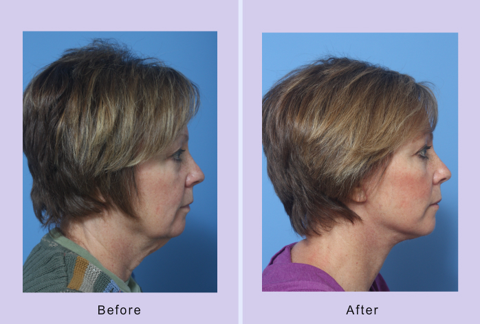 Before and After Image: facelift – case 15 - other