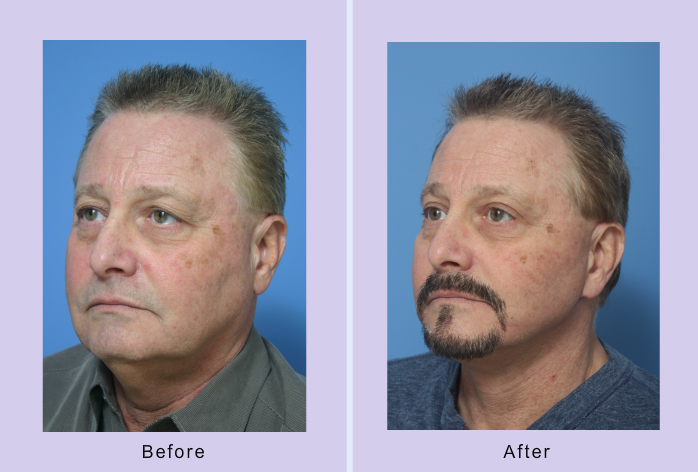 Before and After Image: facelift – case 16 - left-front-oblique