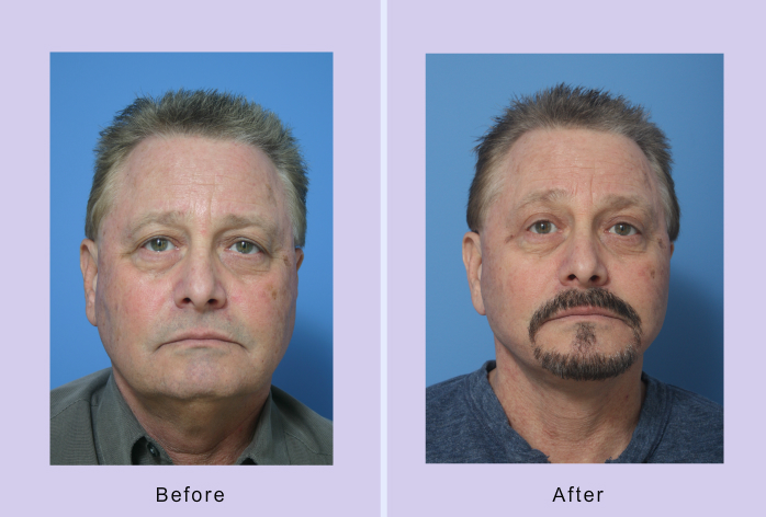Before and After Image: facelift – case 16 - front