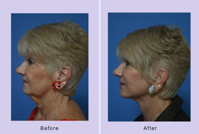 Before and After Image: Lower Facelift – Case 17 - left-side