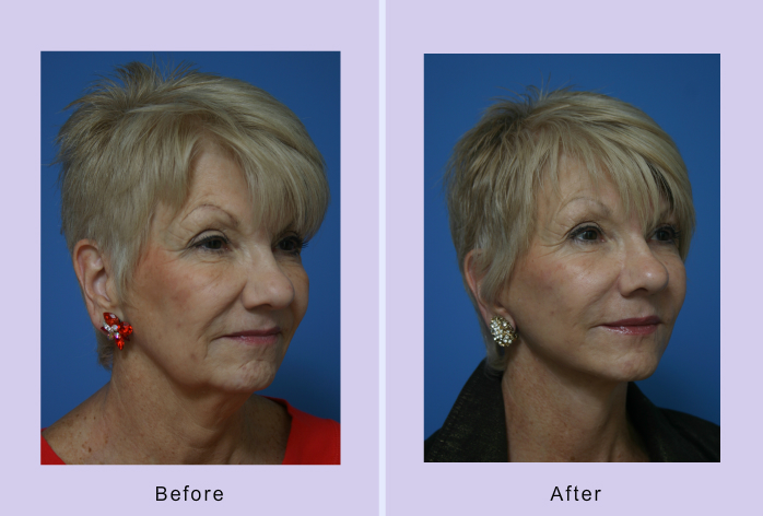 Before and After Image: Lower Facelift – Case 17 - right-front-oblique