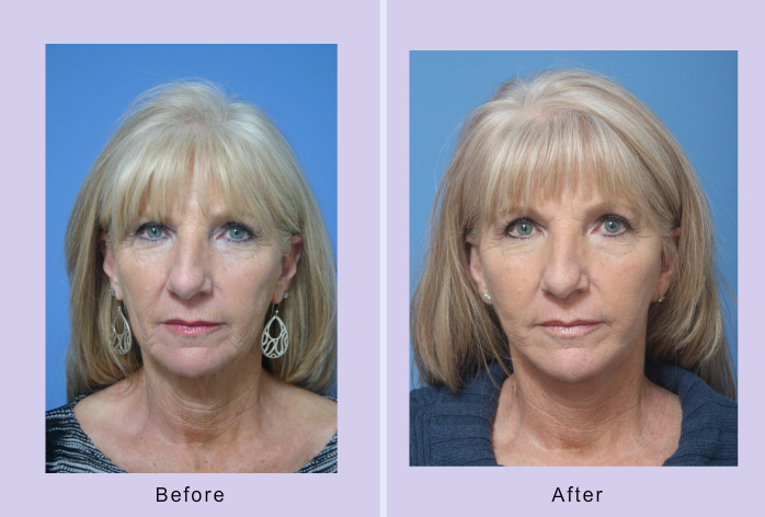 Before and After Image: Lower Facelift – Case 18 - front