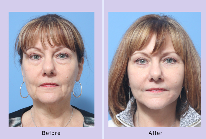 Before and After Image: Lower Facelift – Case 19 - front