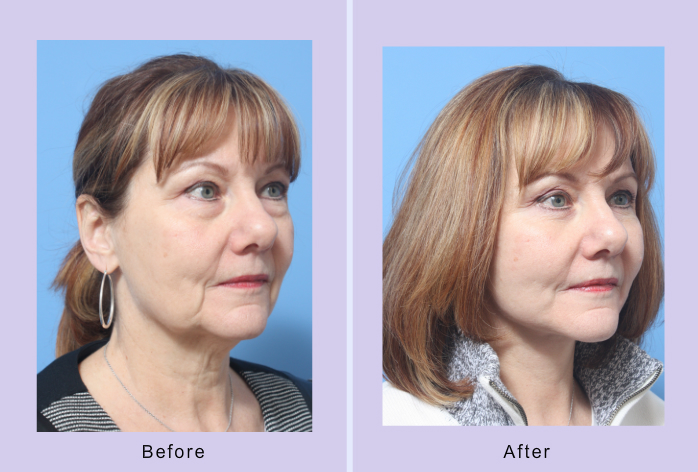 Before and After Image: Lower Facelift – Case 19 - right-front-oblique