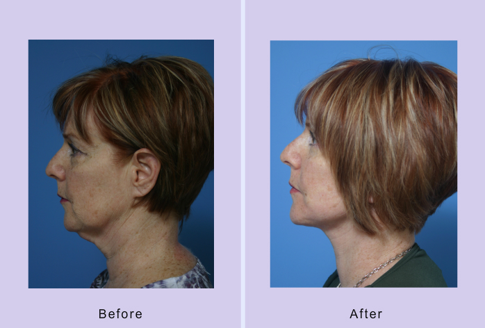 Before and After Image: Lower Facelift – Case 20 - left-side