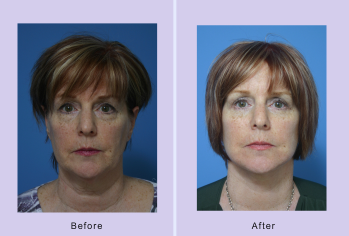 Before and After Image: Lower Facelift – Case 20 - front