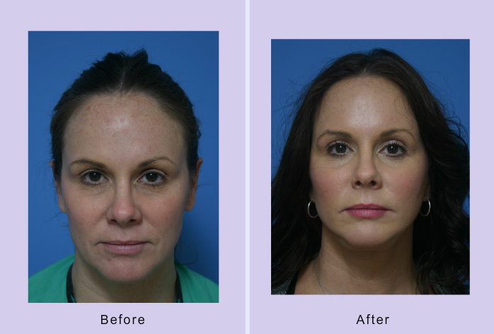 Before and After Image: facial fat grafting – case 12 - front
