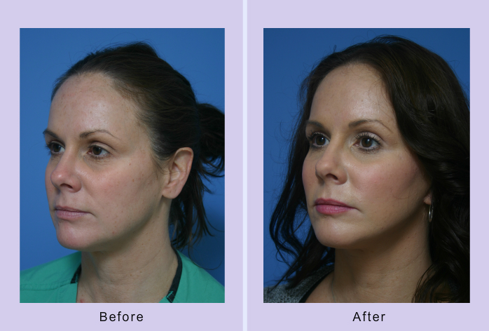Before and After Image: facial fat grafting – case 12 - left-front-oblique