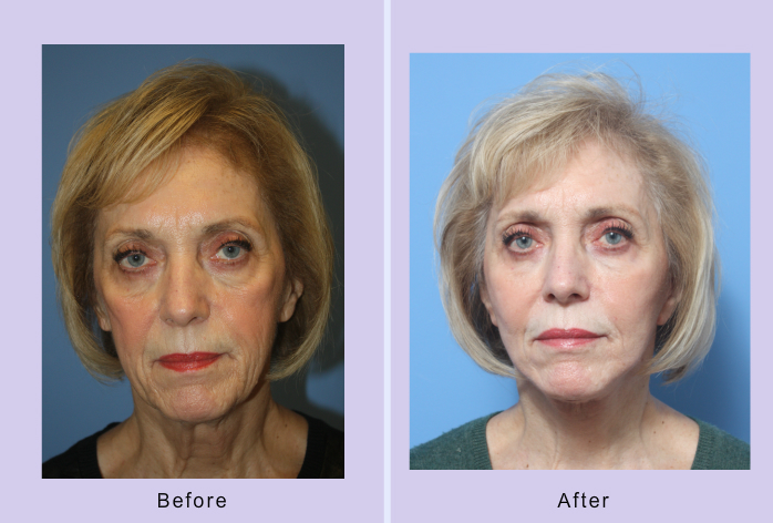 Before and After Image: facial fat grafting – case 14 - front