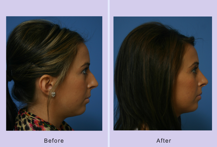 Before and After Image: Rhinoplasty – Case 7 - other