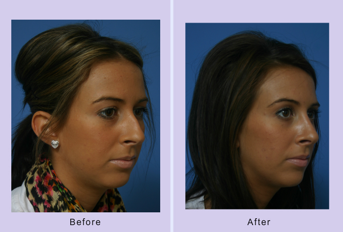 Before and After Image: Rhinoplasty – Case 7 - right-front-oblique