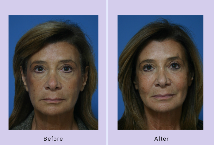 Before and After Image: Sculptra – case 1 - front
