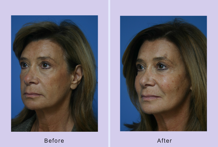 Before and After Image: Sculptra – case 1 - left-front-oblique