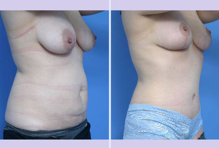Before and After Image: mommy makeover – case 3 - right-front-oblique