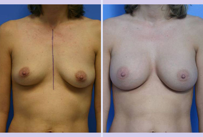 Before and After Image: breast augmentation – Case 2 - front
