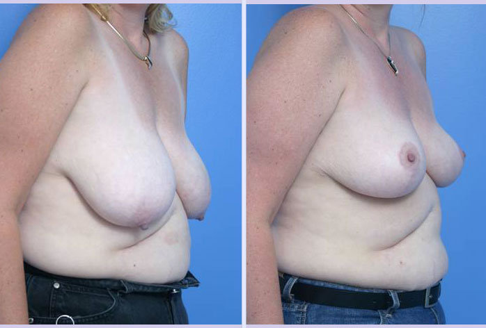 Before and After Image: breast reduction – case 1 - front