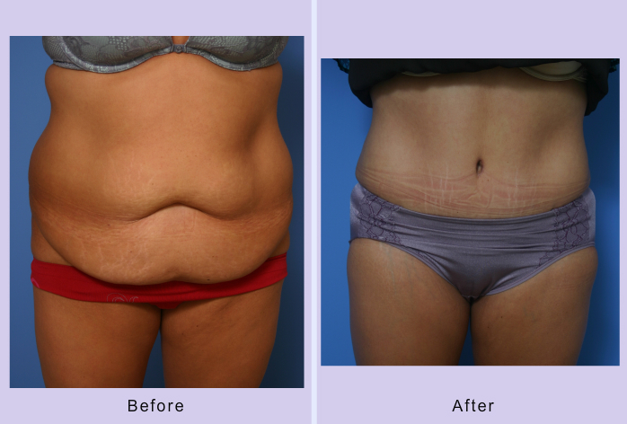 Before and After Image: abdominoplasty – tummy tuck – Case 16 - front