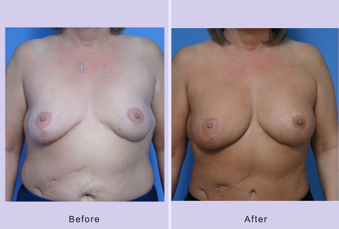 Before and After Image: breast correction – case 8 - front