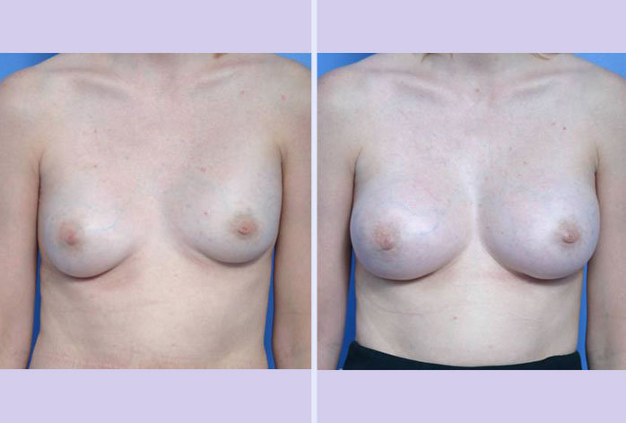 Before and After Image: breast correction – case 3 - front