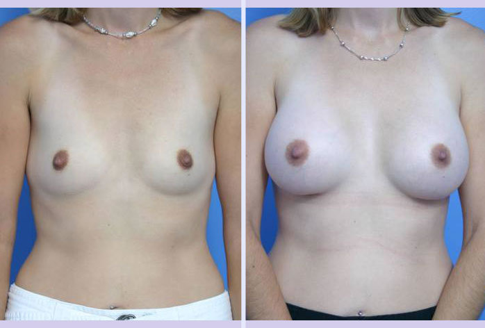 Before and After Image: breast augmentation – Case 5 - front