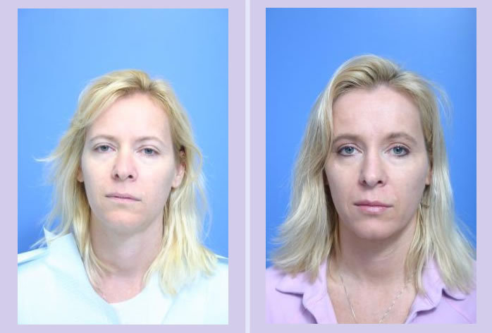 Before and After Image: facial fat grafting – case 6 - front