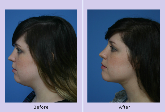 Before and After Image: submental liposuction – case 4 - left-side