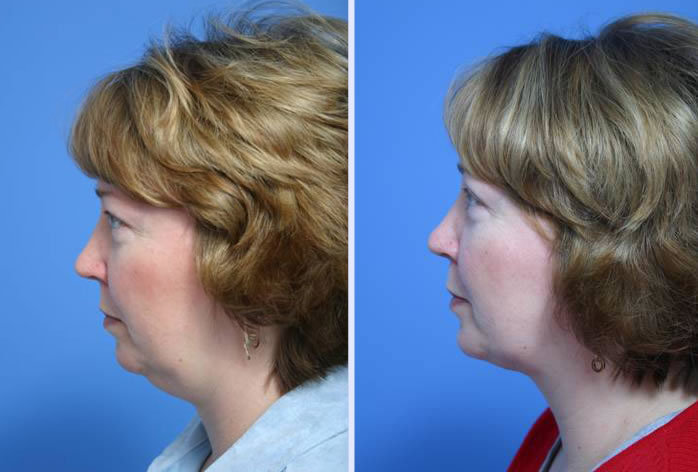 Before and After Image: submental liposuction – case 2 - left-side