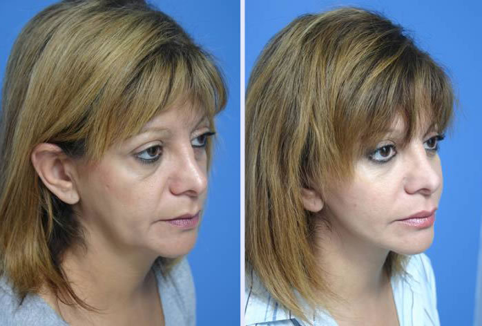 Before and After Image: 3-d volumetric facelift – case 3 - right-front-oblique