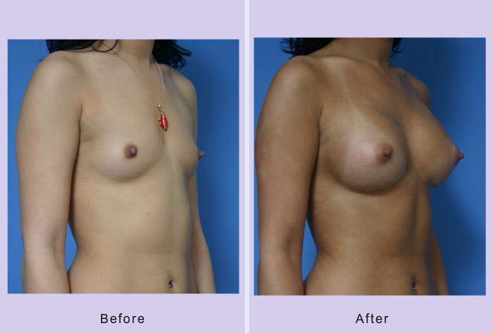 Before and After Image: breast augmentation – Case 22 - right-front-oblique