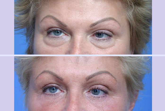 Before and After Image: blepharoplasty – case 2 - other