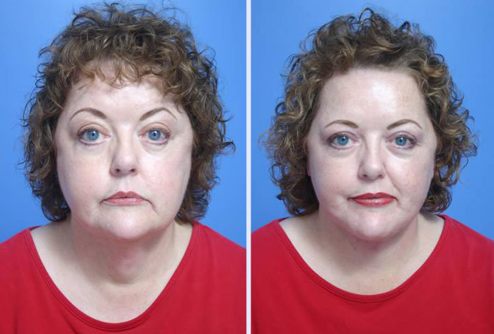 Before and After Image: facelift and mini facelift – case 8 - front
