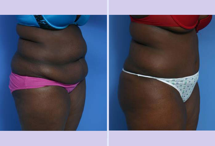 Before and After Image: abdominoplasty – tummy tuck – Case 21 - right-front-oblique