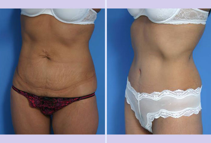Before and After Image: abdominoplasty – tummy tuck – Case 4 - left-front-oblique
