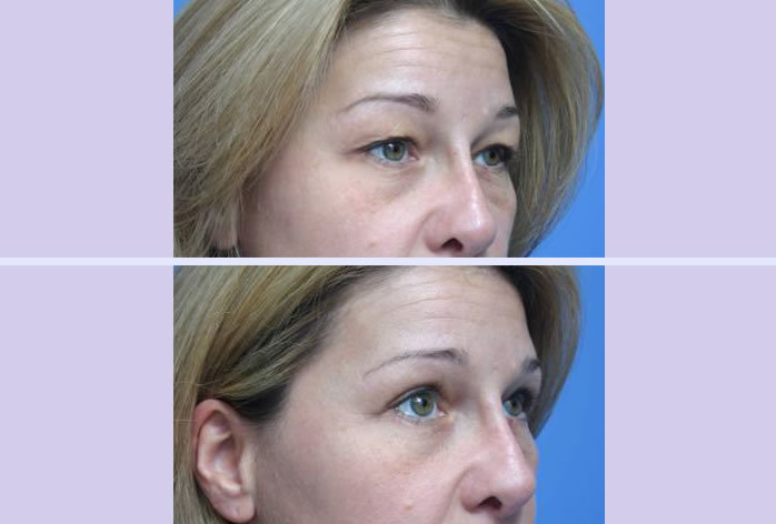 Before and After Image: blepharoplasty – case 7 - other