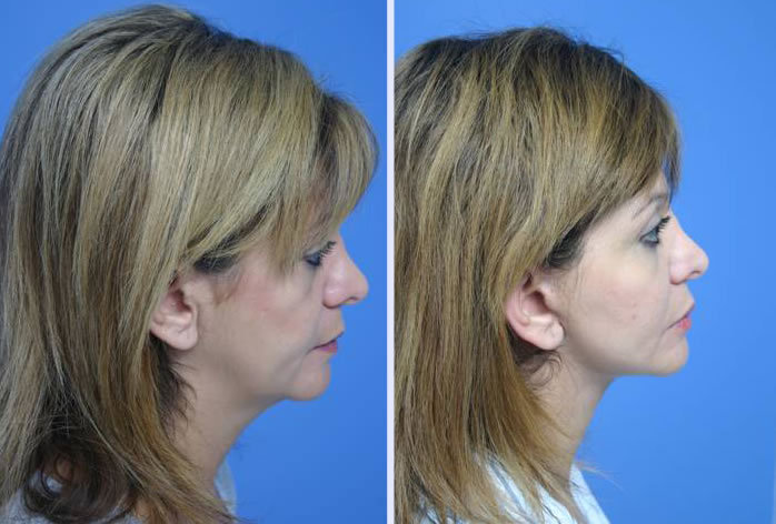 Before and After Image: 3-d volumetric facelift – case 3 - right-side