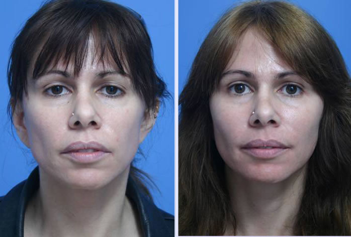 Before and After Image: blue peel – case 1 - front