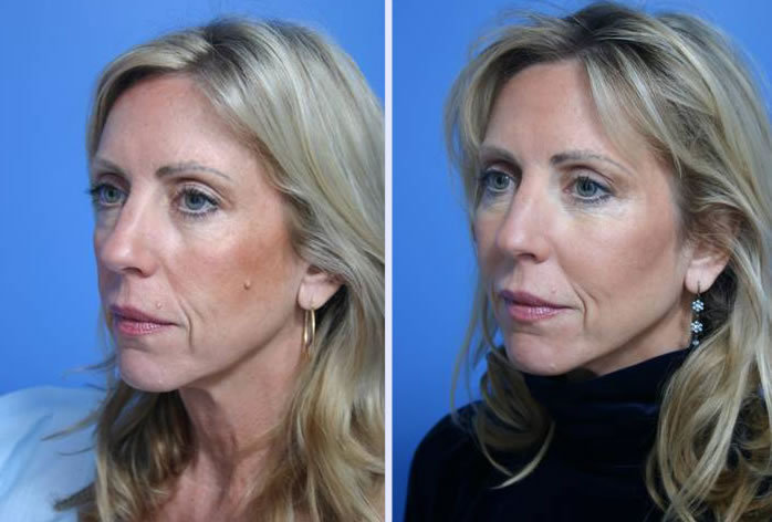 Before and After Image: facial reshaping – case 5 - left-front-oblique