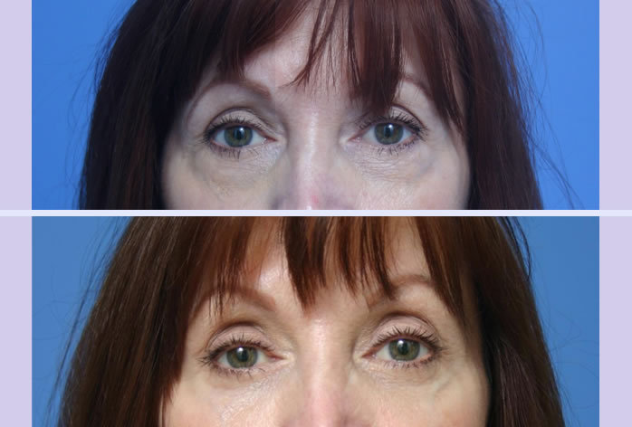 Before and After Image: blepharoplasty – case 8 - front