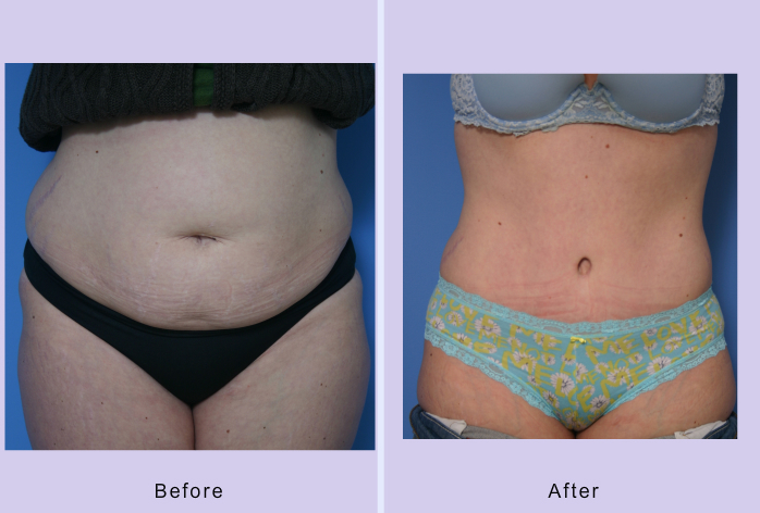 Before and After Image: abdominoplasty – tummy tuck – Case 15 - front