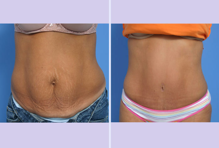 Before and After Image: abdominoplasty – tummy tuck – Case 13 - front