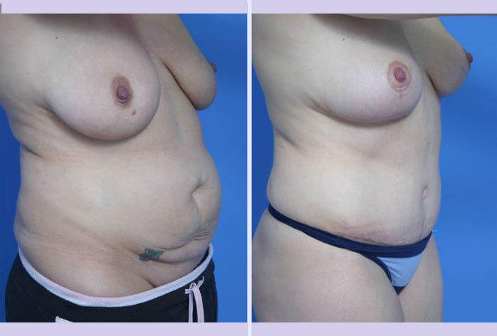 Before and After Image: abdominoplasty – tummy tuck – Case 23 - right-front-oblique
