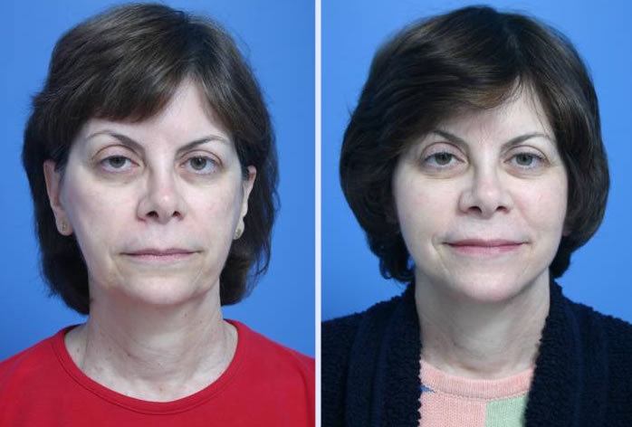 Before and After Image: 3-d volumetric facelift – case 2 - front